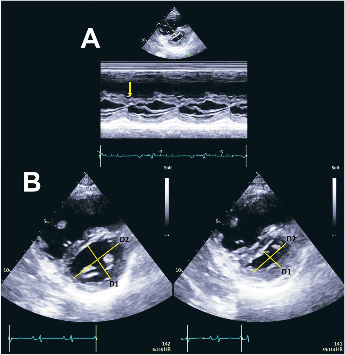 American Society of Echocardiography tweet media