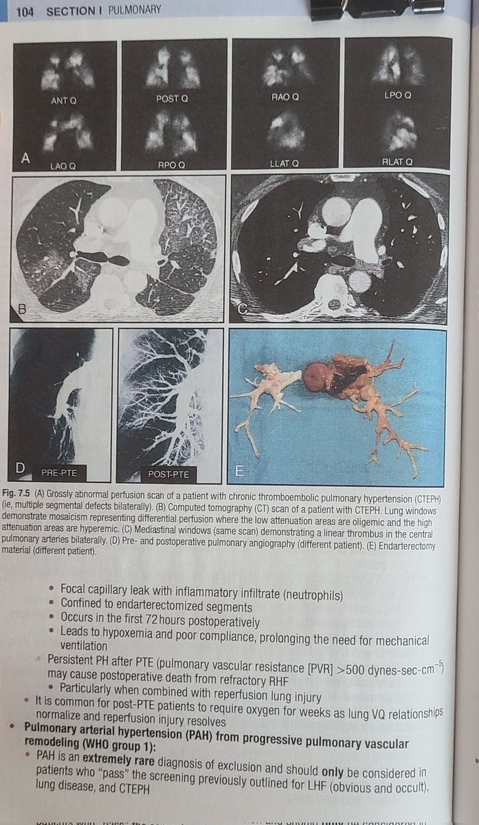 Indeed! CTEPH common mistakes:
1) Not an accumulation of PEs over time

2) Progressive PH and RHF occur without new perfusion defects

3) Transient, new O2 requirement common post operatevily
#MedTwitter #MedEd #pulmonary #criticalcare #hospitalist #cteph #CardioTwitter PRTIYL