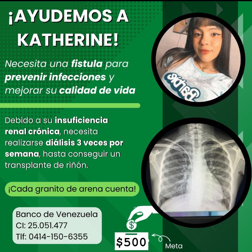 Kornissues_'s tweet photo. Hola amigos, vengo a pedirles su ayuda para poder colocarme una Fistula con un cirujano cardiovascular. 

Contexto: hace 8 meses me diagnosticaron Insuficiencia Renal Crónica e hipertensión. Desde entonces asisto a dialisis 3 veces por semana para poder vivir + https://t.co/FEWEEEDPar