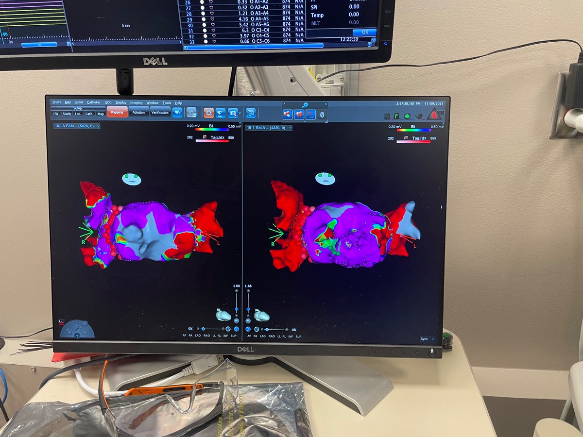 First pass isolation of Right and left pulmonary veins … minimal fluoro time …Owe it to the excellent guidance from Guru like Steve Shorofsky !! Great mentors are not on twitter 😂 #EPeeps  #@UM_Cardiology <a href="/MondalSamhati/">Samhati Mondal MBBS, MD, MS, FASE</a>
