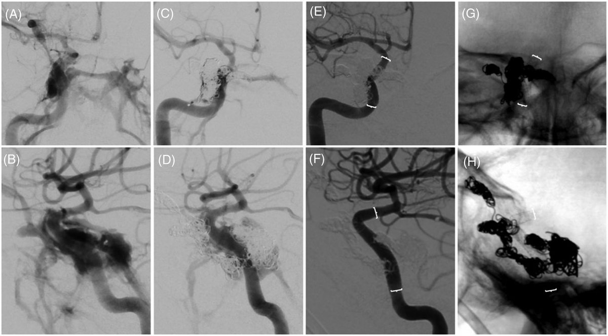 Check out these Direct CCFs treated successfully with @BIOTRONIK_US PK Papyrus balloon mounted coronary covered stents. Potential back up tool for difficult cases. @UTHealthHouston @SVINJournal doi.org/10.1161/SVIN.1…