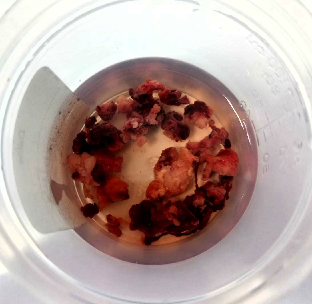 interneumo's tweet photo. Mejora su estado funcional ECOG 1 y es referido a centro de oncología privado para posibilidad de iniciar terapia sistemica y/o inmunoterapia. Se programará nueva broncoscopia intervencionista para criodesvitalización de zonas de implantación tumoral y crioextracción de residuos. https://t.co/BytaAiwQdx