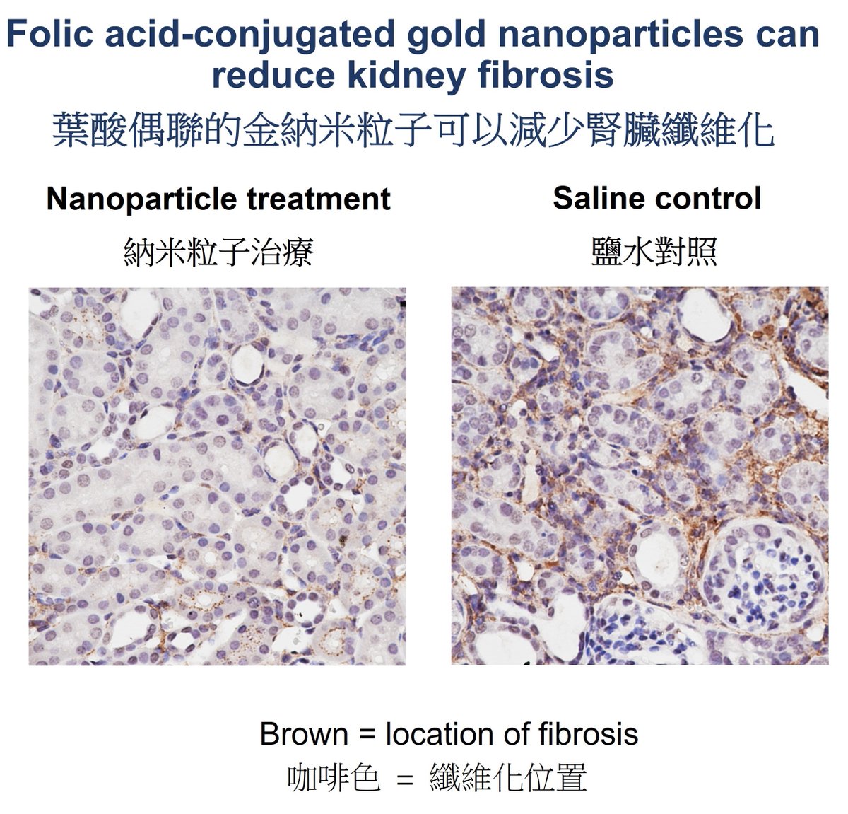 CUHKMedicine's tweet photo. Our researchers @cuhksurgery and @CUHKBME developed a #folic-acid conjugated gold #nanoparticle that may offer a safe, effective treatment for #kidney fibrosis. https://t.co/dEfMkiHnDq

📖@PNASNews: https://t.co/EbaqAy0pw3 https://t.co/cBjd7DHxn9
