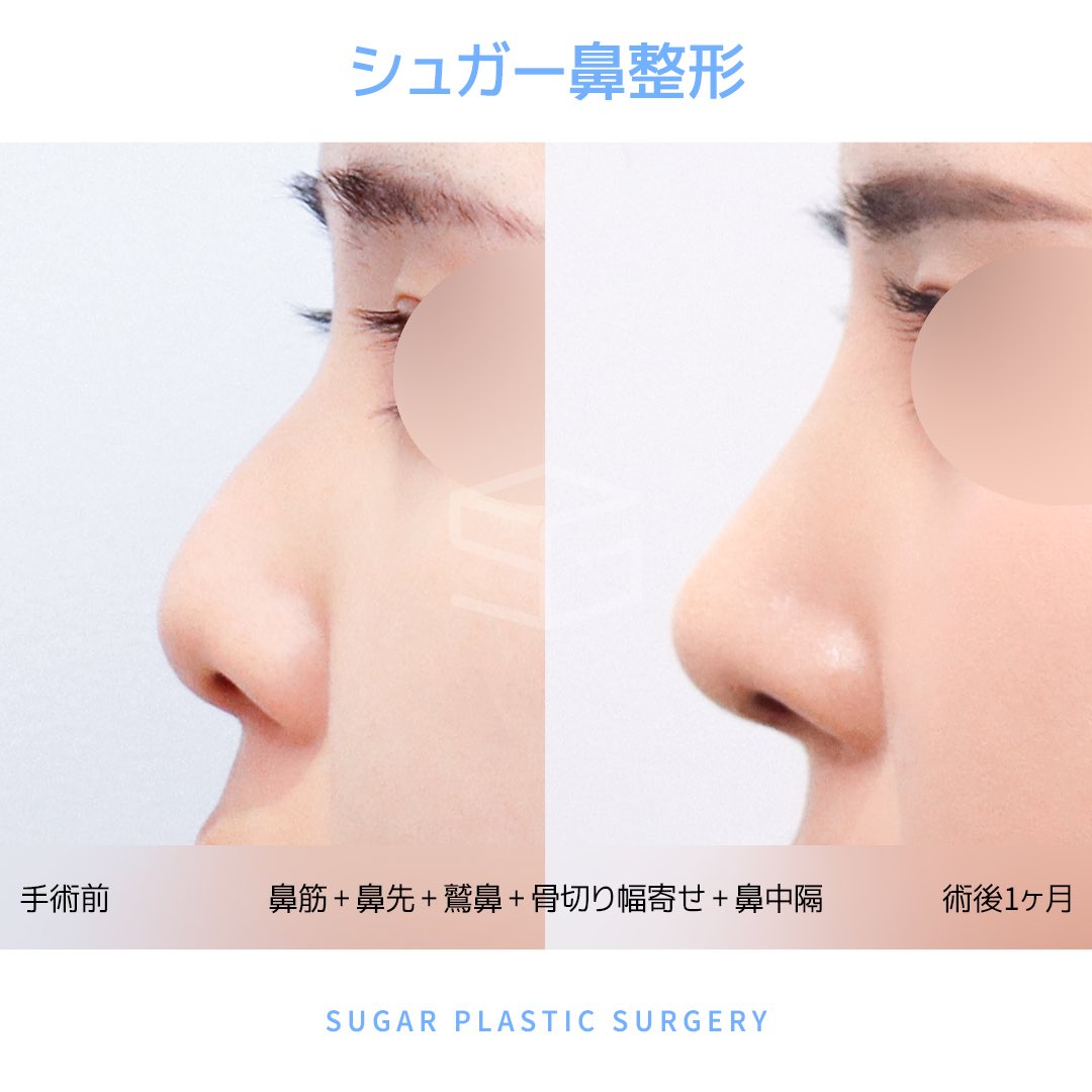 🇰🇷シュガー美容整形外科【目鼻専門】 on X