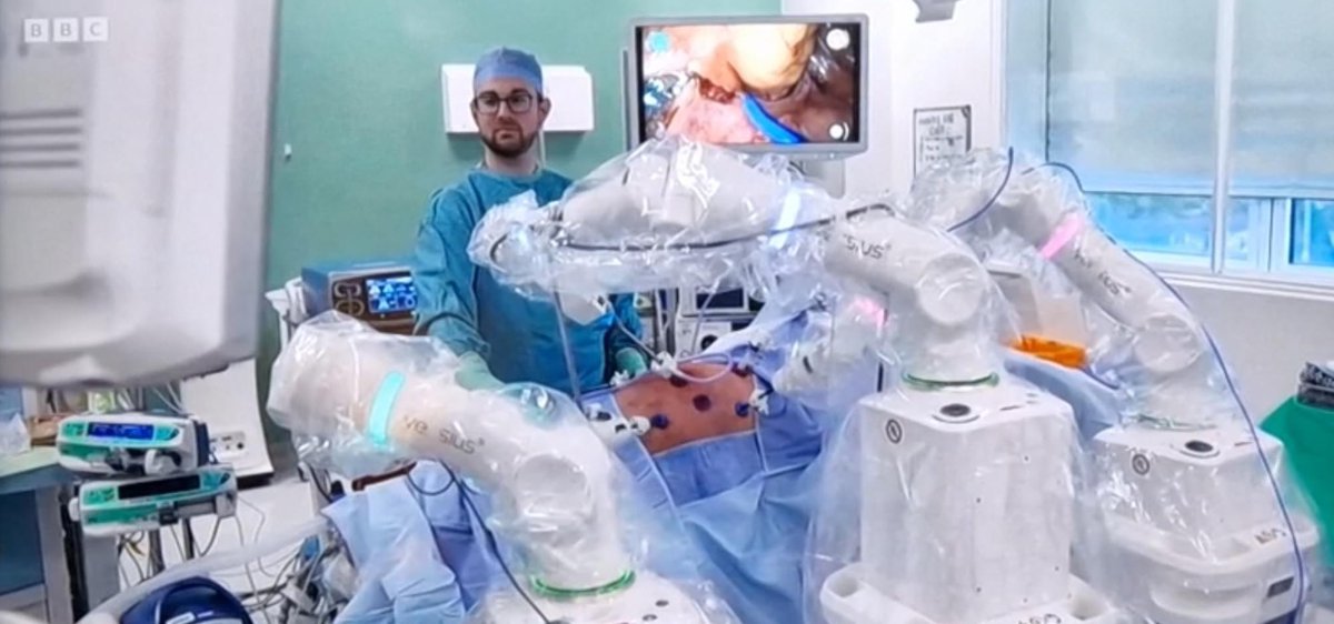 Great to see our #Versius robotic programme @CHFTNHS feature on BBC News last night, we’re already seeing real benefits for patients @CMRSurgical @ArinSaha6 @Laura0505_x @jbcowley