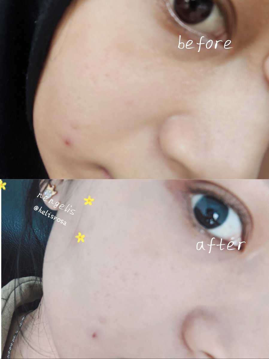 Kadang kalo pakai sunscreen ga cocok di kulit bisa bikin sensitif, muncul jerawat, sama kemerahan.
Liat skrg kemerahan nya udah ilang, happy bgt bisa nemuin sunscreen lokal ter worth it yg bisa meredakan jerawat dan kemerahan di kulit wajah aku 🤗