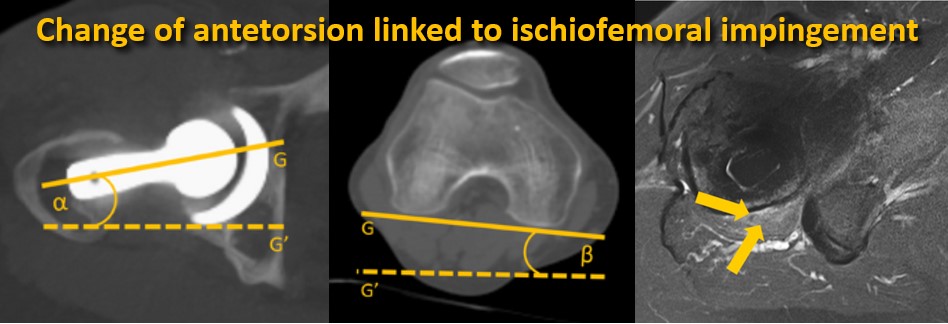 New #OpenAccess article: doi.org/10.1007/s00330…

Change of femoral antetorsion is linked to #ischiofemoral impingement in patients with total hip arthroplasty. Antetorsion increased from 18.2° to 22.5° after surgery.

@derbalgrist ǀ @UZH_en ǀ @BalgristCampus ǀ #MSKrad ǀ #Hip
