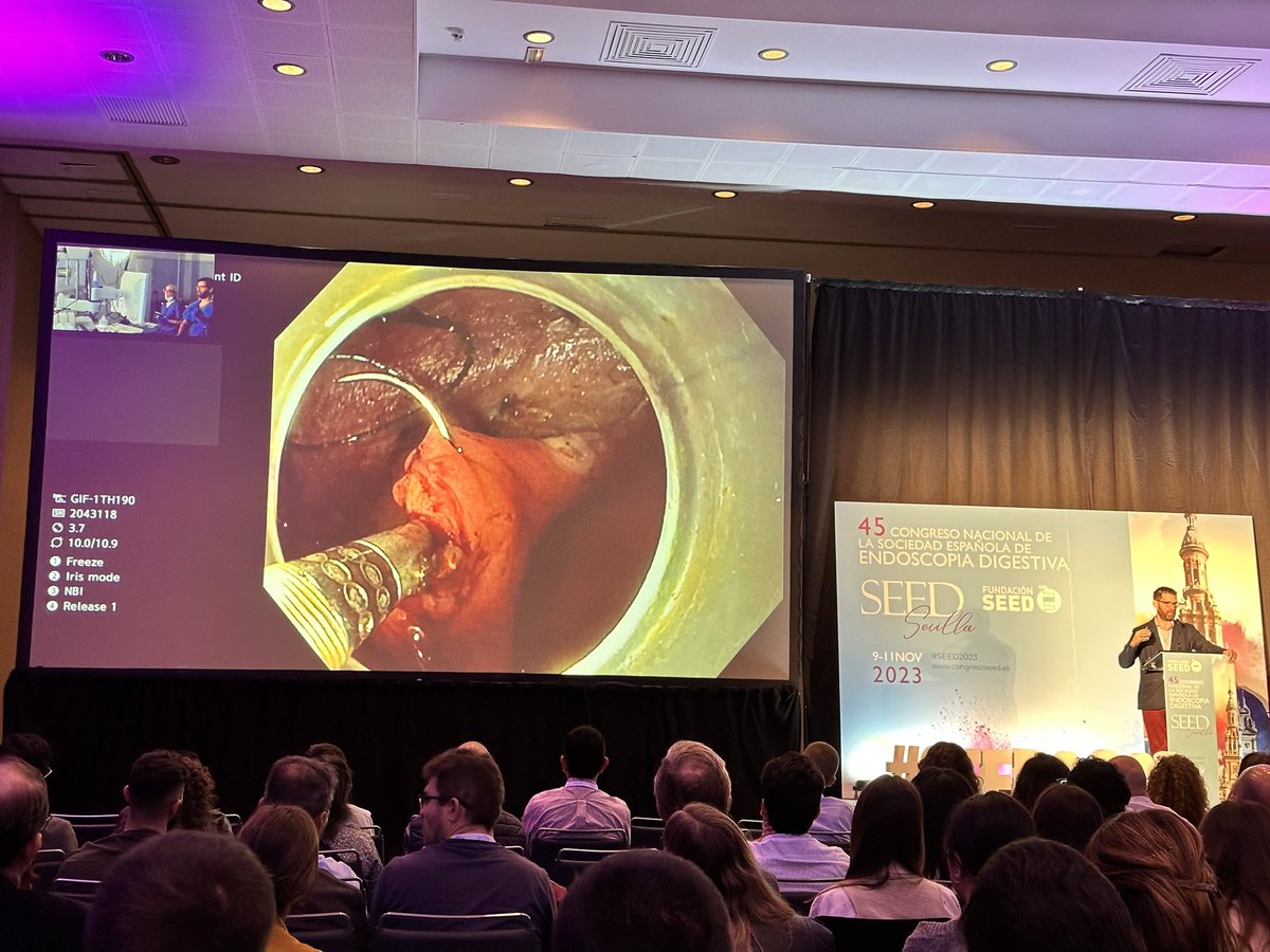 🪡 Sutura endoscopia para el cierre de escaras 

👨‍⚕️<a href="/Pedro_Roson/">Pedro J. Rosón</a>  brillante exposición y demostración de la innovación

<a href="/SEEDendoscopia/">SEED</a> #SEED2023