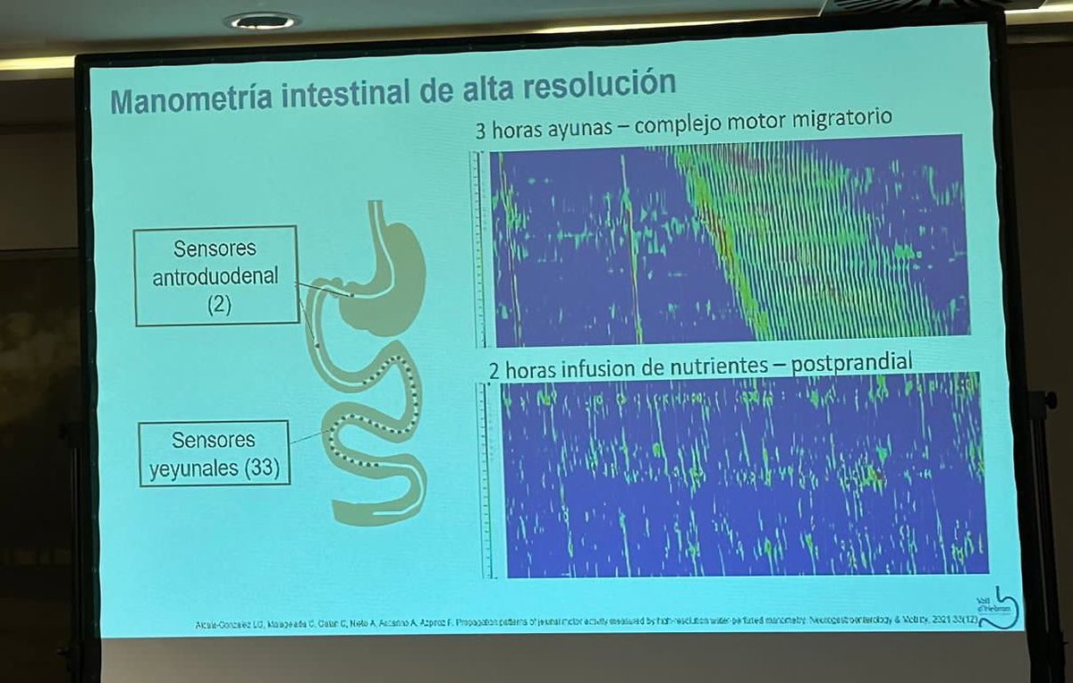 Luis Gerardo Alcala Gonzalez (@alcala_glez_lg) on Twitter photo La afectación intestinal es la segunda causa de mortalidad en la esclerodermia.
En el hospital <a href="/vallhebron/">Vall d'Hebron</a>, estamos trabajando para diagnosticarla en fases más precoces y, esperemos, poder detener su progresión.
<a href="/SociedadSEMAIS/">Sociedad SEMAIS</a> <a href="/MIVHSistemiques/">U. M. Sistèmiques. Medicina Interna H. V. d'Hebron</a> <a href="/AEEsclerodermia/">A. E. Esclerodermia</a> La afectación intestinal es la segunda causa de mortalidad en la esclerodermia.
En el hospital <a href="/vallhebron/">Vall d'Hebron</a>, estamos trabajando para diagnosticarla en fases más precoces y, esperemos, poder detener su progresión.
<a href="/SociedadSEMAIS/">Sociedad SEMAIS</a> <a href="/MIVHSistemiques/">U. M. Sistèmiques. Medicina Interna H. V. d'Hebron</a> <a href="/AEEsclerodermia/">A. E. Esclerodermia</a>
