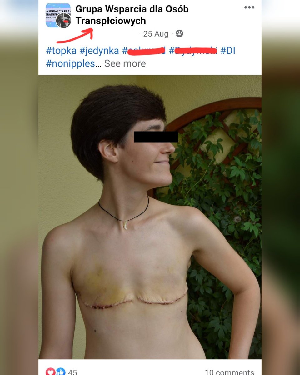 myslozbir's tweet photo. Oto skutki #gender:
Kobieta z dumą prezentuje swoje okaleczone ciało, pozbawione piersi. Post oznaczyła tagiem #nonipples - "bez sutków".
Amputowanie zdrowych piersi i usuwanie sutków to często rytuał inicjacji w środowisku #gender. Nienawiść do kobiecości jest tam powrzechna. https://t.co/WGUIvD5kIL