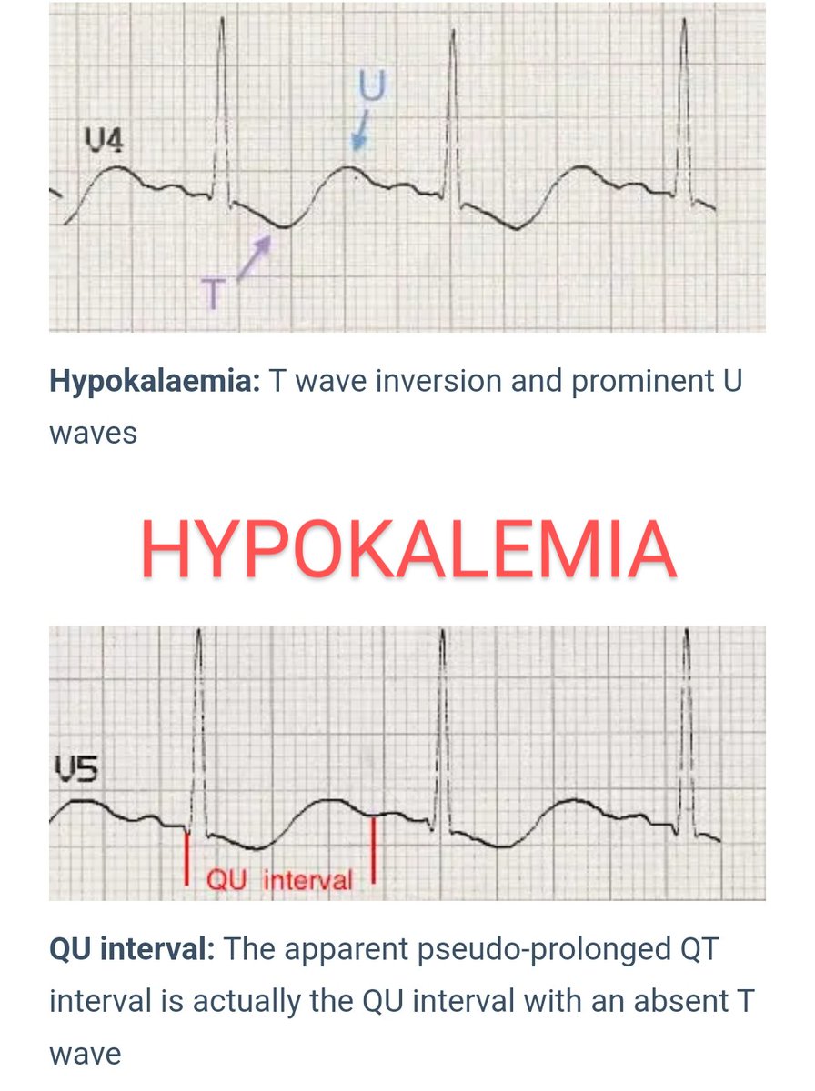 💥In case of life-threatening arrhythmias associated with severe hypokalemia, potassium infusion can be given as fast as 100mEq/hr.

A🧵 on important numbers to be kept in mind during  management of 𝗛𝗬𝗣𝗢𝗞𝗔𝗟𝗘𝗠𝗜𝗔💧
 
🔳 Read on 👇

#MedTwitter #MedEd #MedX