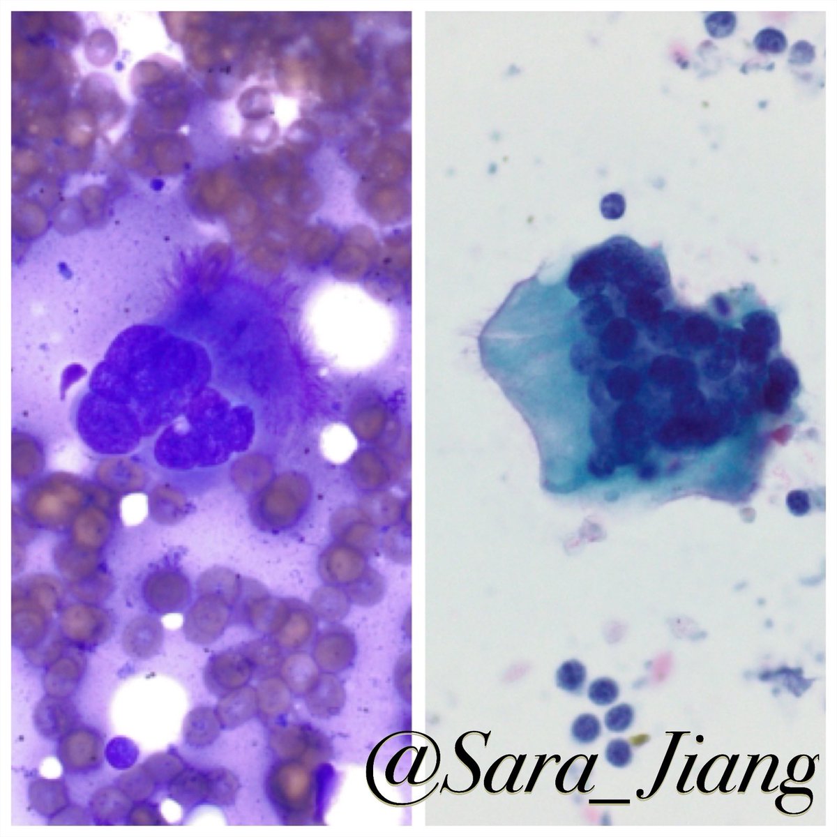 Sara_Jiang's tweet photo. Today’s #FNAFriday #DQvsPAP!
So-called “irritation cells” in BAL, bronchial cells with enlargement and multinucleation
Look for cilia/terminal bars!
🔎 DQ (L) Multiple nuclei may give impression of nuclear irregularities
🔎Pap (R) shows overall smooth nuclear contours https://t.co/sGJYe6UkEd