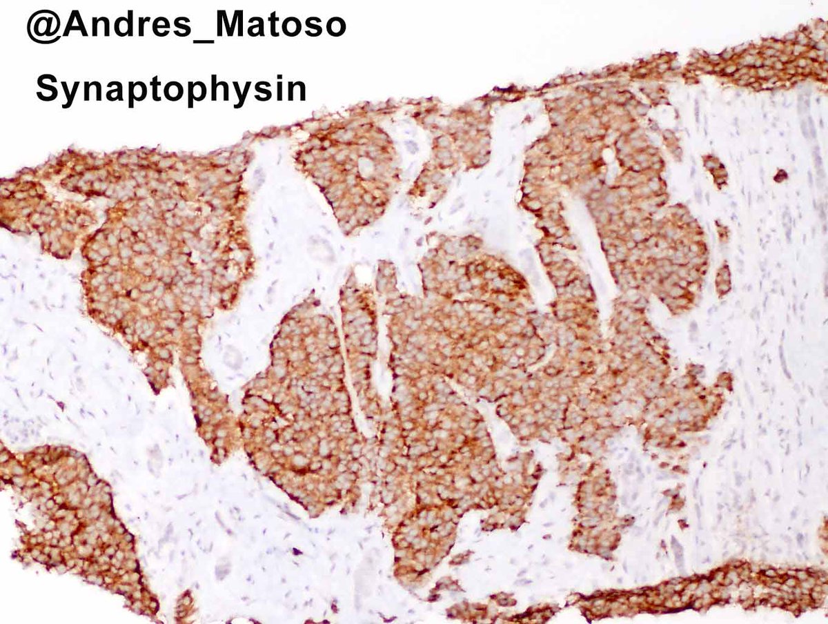 Primary renal carcinoids are extremely uncommon. The characteristic  trabecular pattern might be difficult to identify in a needle biopsy. Monotonous nuclei with inconspicuous nucleoli and abundant eosinophilic cytoplasm are helpful diagnostic clues. Nice weekend everyone!