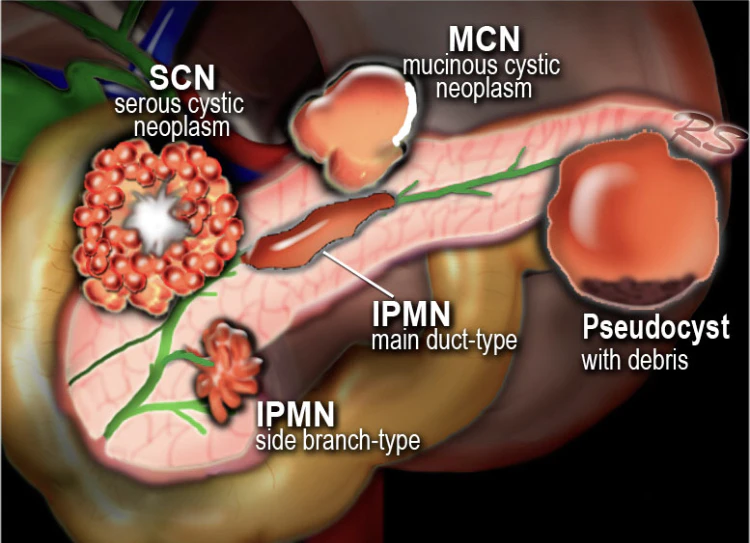 EndoCollabcom's tweet photo. Pancreatic Cysts Categorization 

A Thread 👇 https://t.co/wcRVA3iNVM