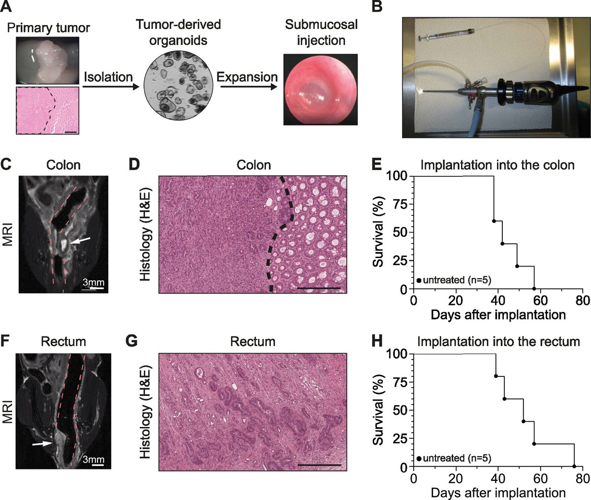 New in the #RedJournal: A novel tumor organoid-based model of rectal cancer RT combines orthotopic tumor growth with therapeutic and diagnostic patient care workflows to improve translational research. <a href="/Fischer_J_C/">Julius C. Fischer</a> <a href="/MarTschu/">Markus Tschurtschenthaler</a> @h_felchle bit.ly/fischer2