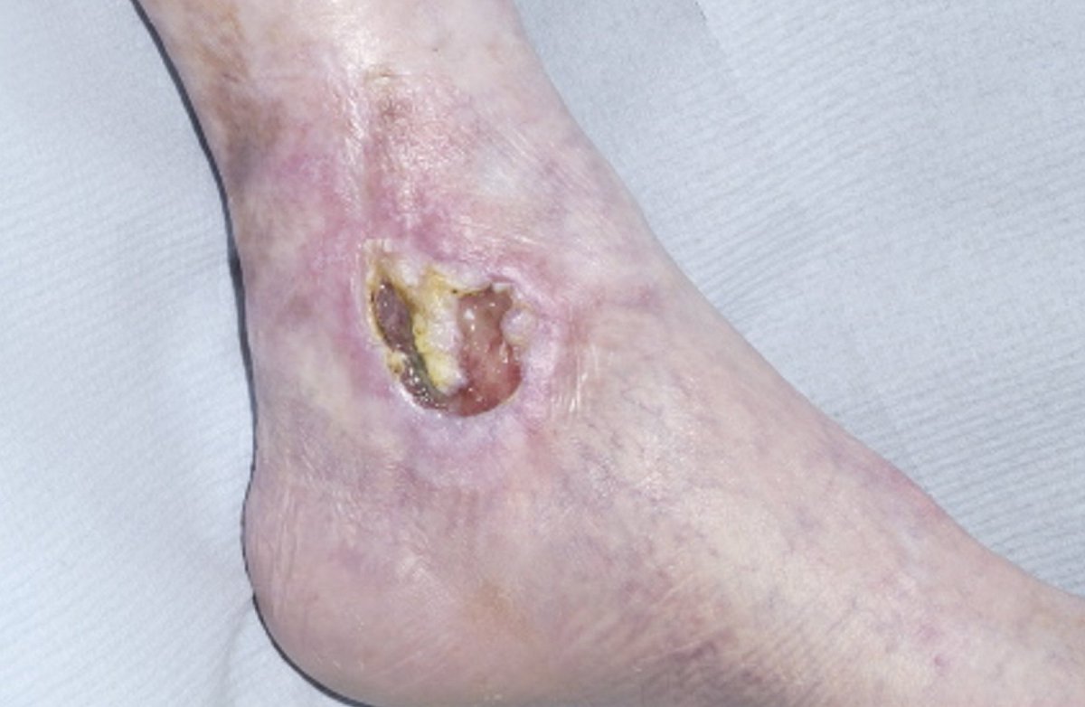 Top Tip Tuesday - Use a torch to really see that wound bed when assessing your wounds - it's surprising what more you can see! #woundhealing #woundhealingtips #ᴡᴏᴜɴᴅʜᴇᴀʟɪɴɢ #toptip #toptips