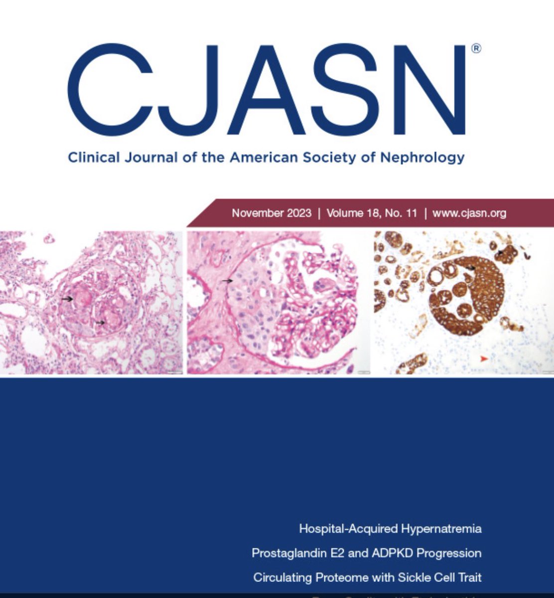 MPAlexanderMD's tweet photo. Crescent-like involvement of the Bowman’s capsule by carcinoma. 
@mariacharkviani @CJASN @ASNKidney https://t.co/NdhNNBTS8j