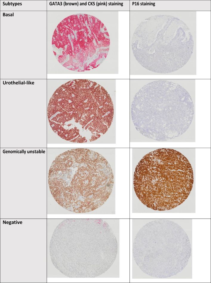 European Urology Open Science (@eururolopen) on Twitter photo Feasibility and Impact of Immunohistochemistry-based Molecular Subtyping for Muscle-invasive Bladder Cancer in Patients Treated with Radiation-based Therapy
buff.ly/47hR8M8
<a href="/charleshesswani/">Charles Hesswani</a> <a href="/gautiermarcq/">Gautier Marcq</a> <a href="/dr_rkool/">Ronald Kool</a> <a href="/JoseJoaoMansure/">Jose Joao Mansure</a> <a href="/fadbrimo/">Fadi Brimo</a> <a href="/virchow/">David M. Berman</a>
#bladdercancer Feasibility and Impact of Immunohistochemistry-based Molecular Subtyping for Muscle-invasive Bladder Cancer in Patients Treated with Radiation-based Therapy
buff.ly/47hR8M8
<a href="/charleshesswani/">Charles Hesswani</a> <a href="/gautiermarcq/">Gautier Marcq</a> <a href="/dr_rkool/">Ronald Kool</a> <a href="/JoseJoaoMansure/">Jose Joao Mansure</a> <a href="/fadbrimo/">Fadi Brimo</a> <a href="/virchow/">David M. Berman</a>
#bladdercancer