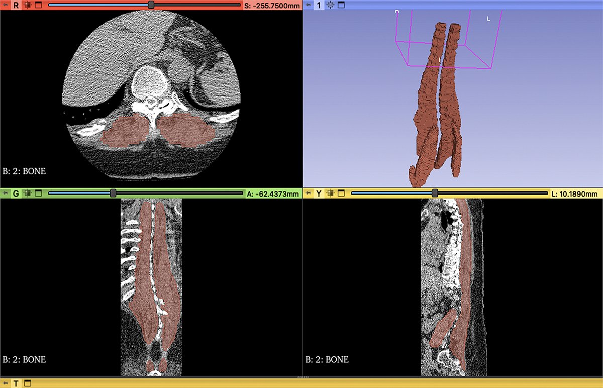 Article examines application of machine learning for automatic segmentation of paraspinal musculature. sciencedirect.com/science/articl… <a href="/SamuelAdida/">Samuel Adida</a> <a href="/adlegarreta/">Andrew Legarreta</a> <a href="/js_hudson/">Joseph Hudson</a> <a href="/NitinAgarwalMD/">Nitin Agarwal, M.D.</a>