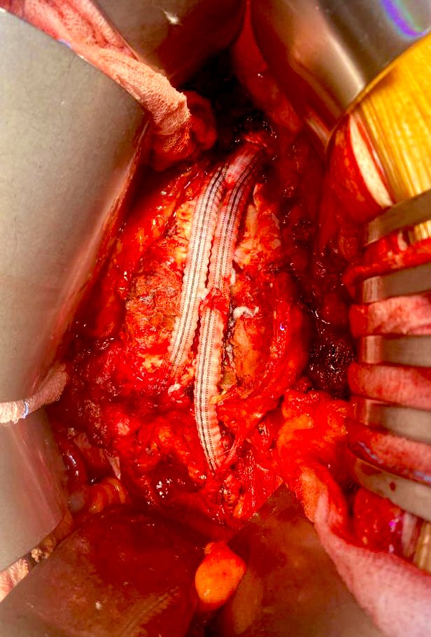 The #veterosurgery of the week. 🎈#aorta