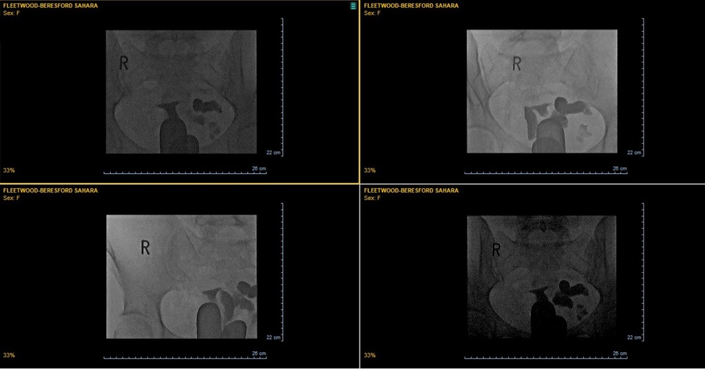 Sahara88uk's tweet image. #FertilityTesting journey | #Hydrosalpinges and hormone problems 🔗 ift.tt/4XndGUg

The results of the #Hysterosalpingogram (HSG) are in. It clearly shows that my left fallopian tube is blocked and filled with fluid. This is called a #hydrosalpi… instagr.am/p/CzeUoPIt0-d/