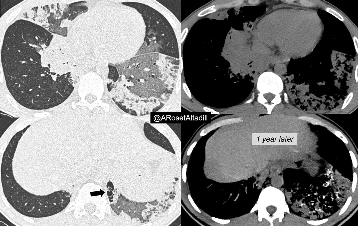 #11 Lipoid pneumonia

🫁 Middle & lower lobes consolidation & GG +/- crazy-paving
🧽 Fat attenuation is not always present due to superimposed inflammation
🔜 Pneumatoceles may occur in the acute setting
⚪️ Calcifications can be seen in the chronic scenario

#radiology #chestrad