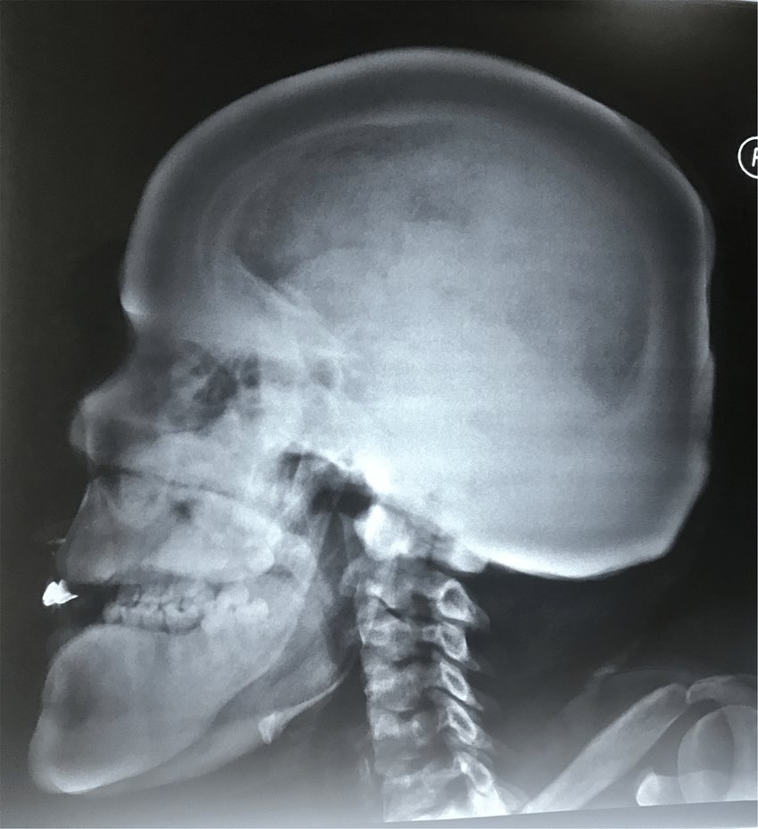 OGdukeneurosurg's tweet image. Describe what you see?