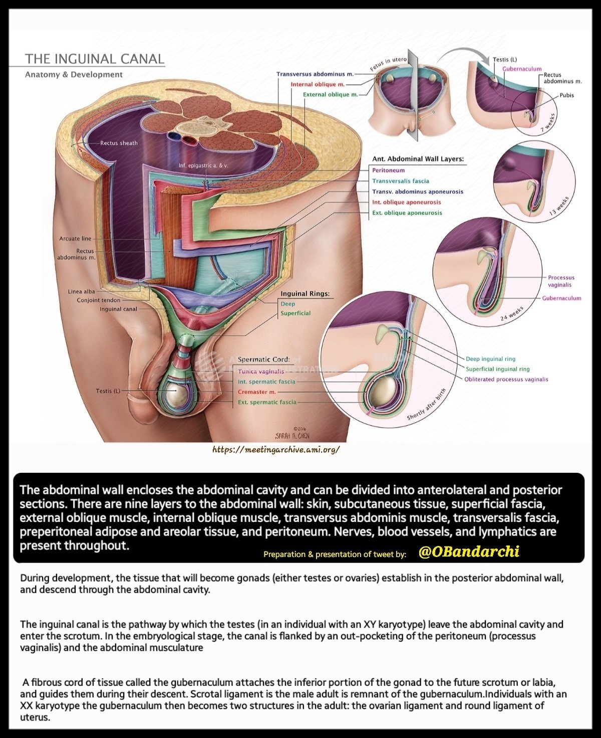 Medicina | Free Full-Text | The Cyst of the Canal of Nuck: Anatomy,  Diagnostic and Treatment of a Very Rare Diagnosis—A Case Report of an  Adult Woman and Narrative Review of the