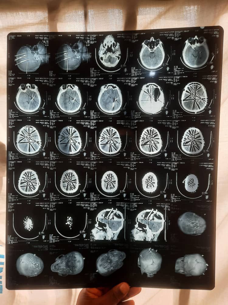 Jayden_Tha's tweet image. This is Dr Ubong Ekpene, a consultant Neurosurgeon in University of Uyo Teaching HospitalHe operated on a man who had 7 long nails hammered into his head . The operation was successful . The patient has been discharged without a single neurological deficit .