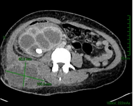 Une pyélonéphrite xanthogranulomateuse Une femme de 40 ans se présente aux urgences pour des douleurs lombaires droites avec de la fièvre depuis plusieurs semaines. L'examen clinique retrouve une collection palpable en regard de la loge lombaire droite et des urines purulentes.