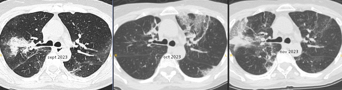 ♀️ 57 yo persistent fever and dyspnea 3 months after COVID-19 pneumonia. Have you seen this 'migrating' behavior of OP after SARS-CoV-2 infection? Is this something more than just an exacerbated inflammatory response to lung injury? #radiology