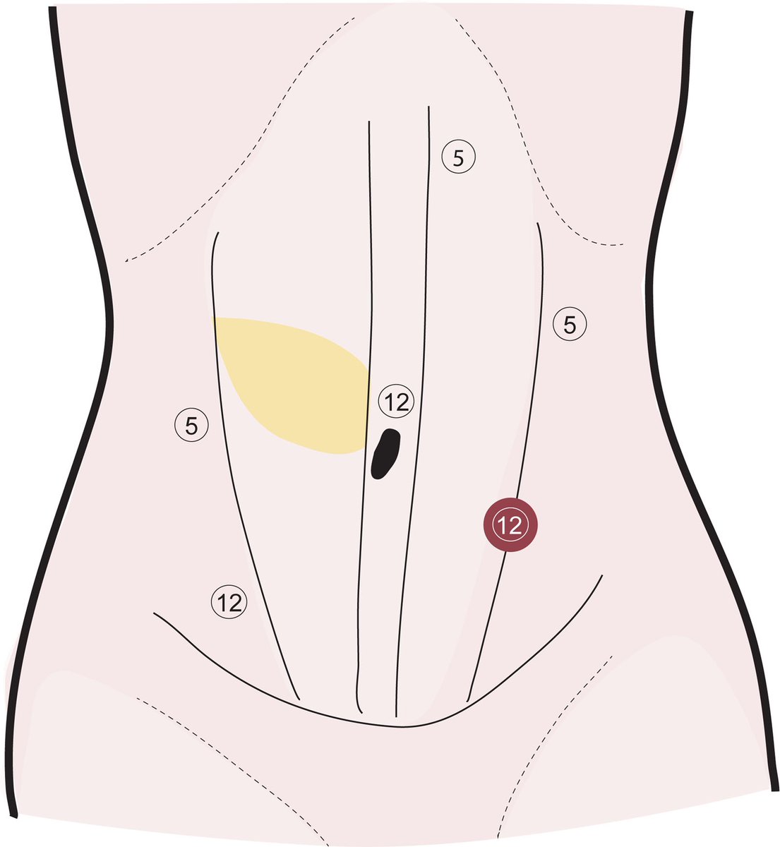 #DCRJournal New Technology Report is OUT! Read more on Laparoscopic oblique rectus abdominis myocutaneous flap harvest for perineal reconstruction after abdominoperineal resection: bit.ly/46qof0q @patsyllamd @JISBMD @ConorDelaneyMD @justinmaykel @KarimAlavi