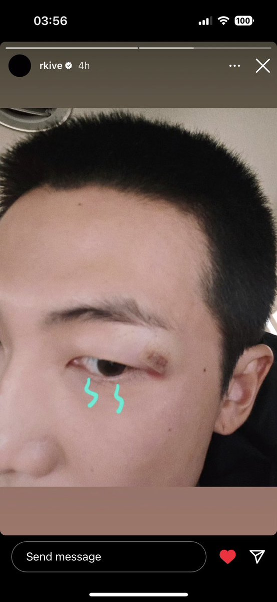 I hope Namjoon’s eyebrow is doing well 😢