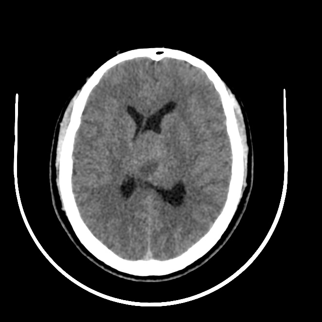 CarolinaMarOv's tweet photo. M, 38 y/o
Persistent headache + blurry vision that worsens at night
#RadRes #HeadCT #radiology #rad
@MohitAgNeurorad https://t.co/g4Tn6BabQL