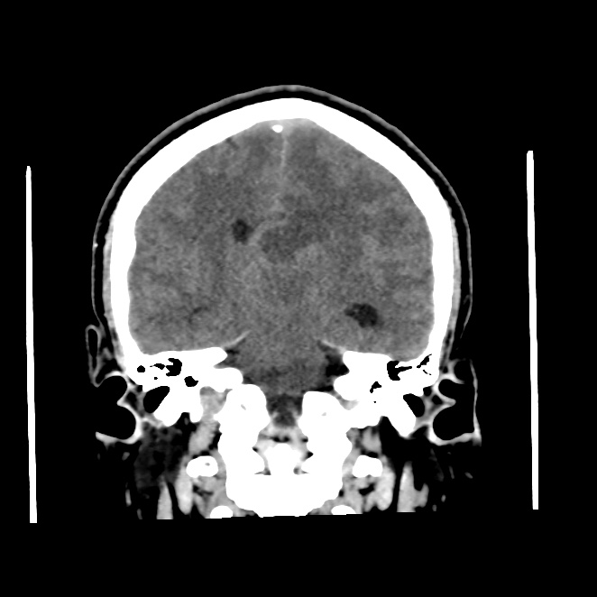 CarolinaMarOv's tweet photo. M, 38 y/o
Persistent headache + blurry vision that worsens at night
#RadRes #HeadCT #radiology #rad
@MohitAgNeurorad https://t.co/g4Tn6BabQL
