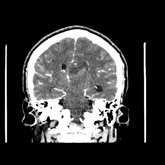CarolinaMarOv's tweet photo. M, 38 y/o
Persistent headache + blurry vision that worsens at night
#RadRes #HeadCT #radiology #rad
@MohitAgNeurorad https://t.co/g4Tn6BabQL