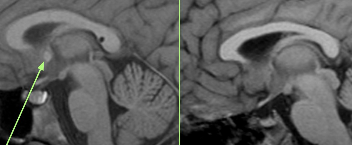 Weekend case: 
The absence of the anterior commissure is to be noted (see normal shown by the green arrow)- this can be a marker of a genetic disorder. In this case, with congenital aniridia, PAX6 mutation confirmed. Look out for something absent this weekend