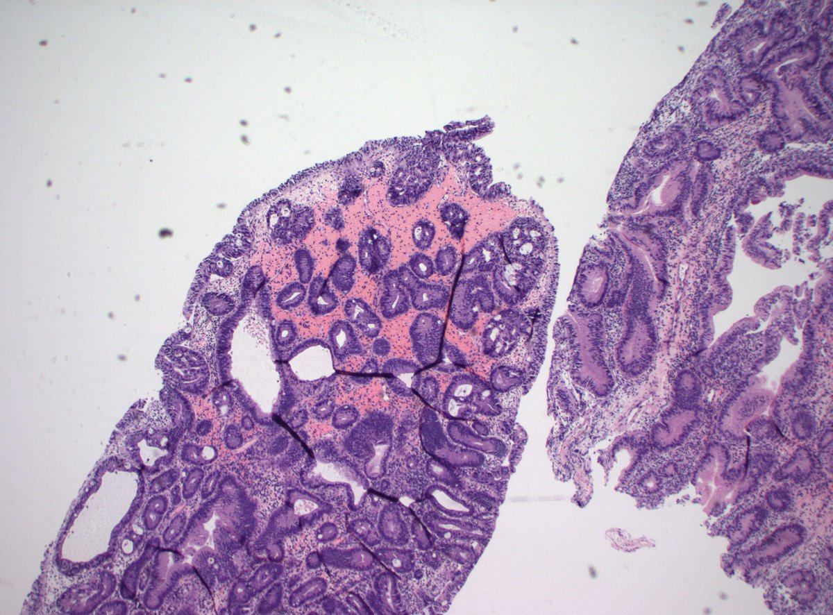 50M w/ longstanding UC, visible polypoid mass in sigmoid colon. HGD or no? #PathTwitter #PathX #GIPath