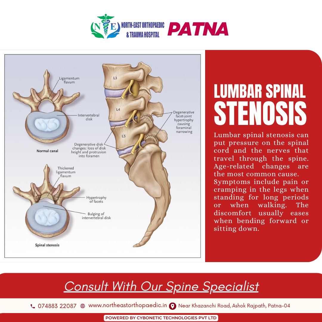 Lumbar spinal stenosis can put pressure on the spinal cord and the nerves that travel through the spine. Age-related changes are the most common cause.

🌐northeastorthopaedic.in

#LumbarSpinalStenosis #SpineDiseases #SpineHealth #SpineProblem #SpinePain #SpinalCord #SpinalHealth