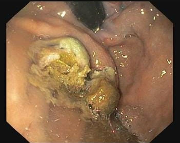 Gastro_Pedia's tweet photo. 4cm huge #gastric_varix in a patient with #CLD #HCC 
Performed 
#EUS guided #coiling with #glue instillation 
Follow-up UGI shows complete obliteration after 1 month

#eus
#GitHub
#GITwitter
#MedEd
#endoscopic_ultrasound
#advancedendoscopy https://t.co/B532c85jKM