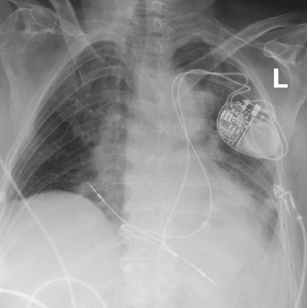 1. What vascular anomaly dose this patient have ? 

2.  How will the  coronary sinus be on Echocardiography?