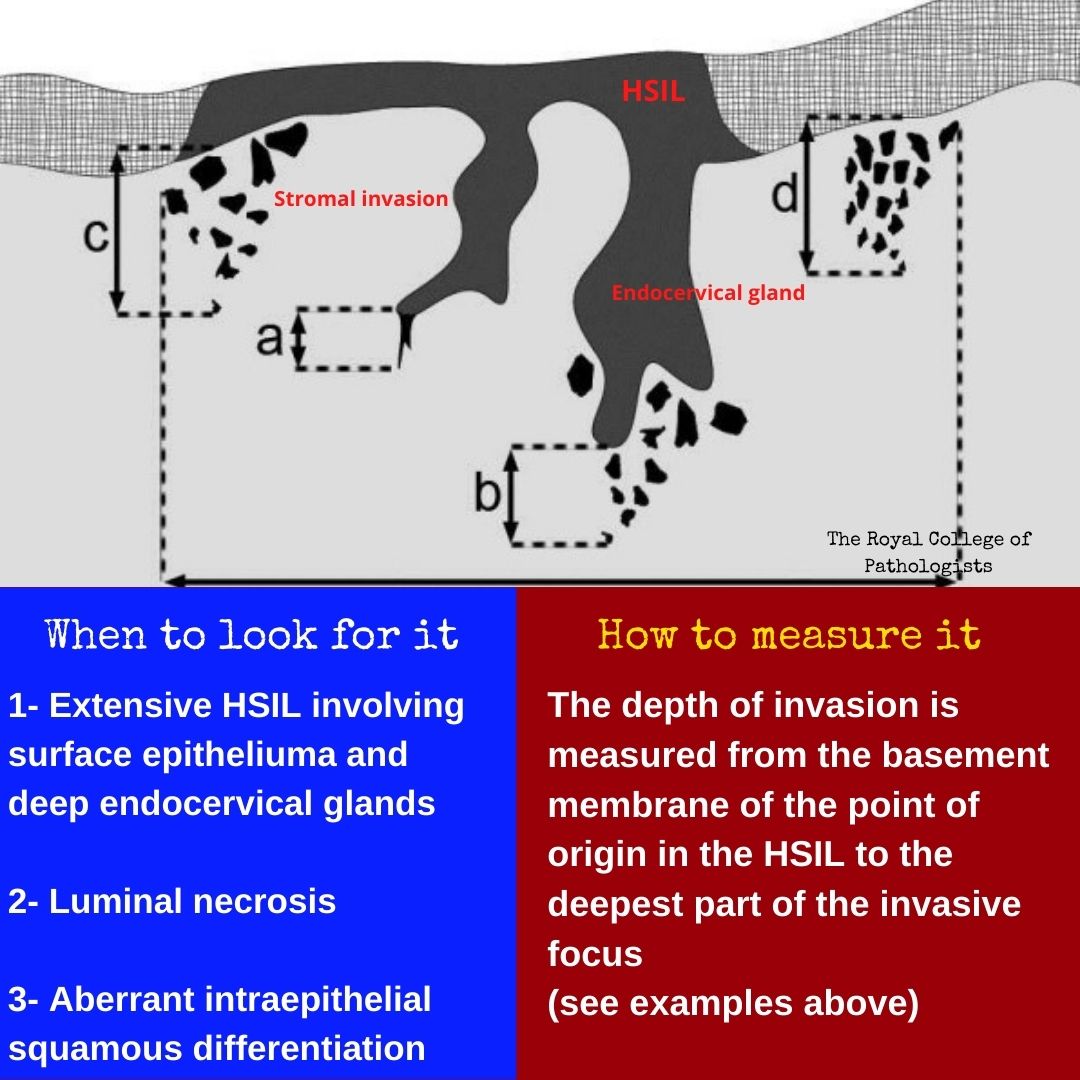 GeronimoJrLapac's tweet image. Uterine Cervix-When to look for and how to measure invasive focus.
A great Saturday everyone !

#gynpath #pathology