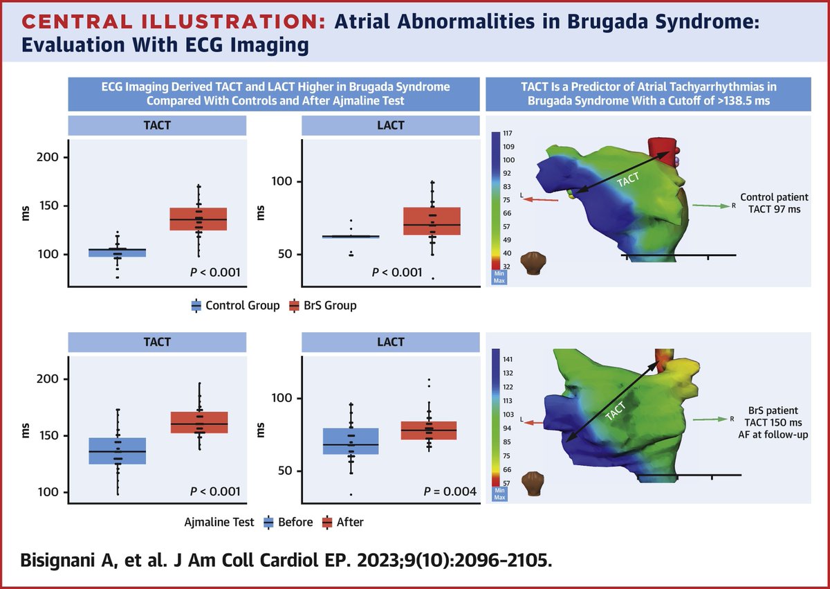ECGI-calculated TACT &amp; LACT are sig. prolonged in Brugada syndrome (BrS) patients compared w/ control patients, &amp; in BrS patients after ajmaline. This may be consistent w/ a concealed atrial #cardiomyopathy in BrS. bit.ly/3MzVzKy

#JACCCEP #EPeeps #ECG <a href="/AntBisignani_MD/">Antonio Bisignani</a>