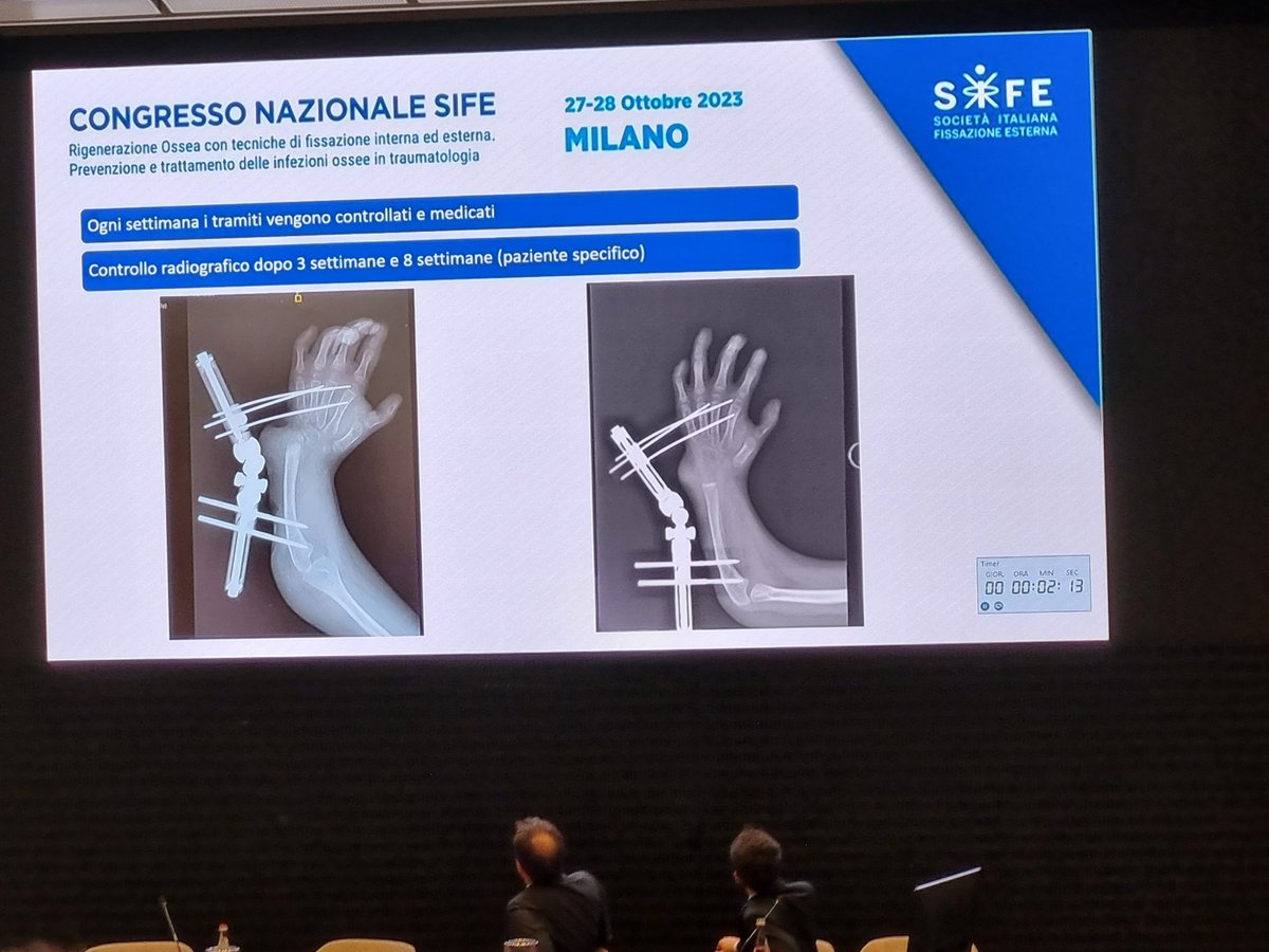 Glad to meet my professor Alexander Kirienko and italian experts again in national congress of SIFE , Milano , Italy with latest updates in Deformity Correction and Limb Lengthening