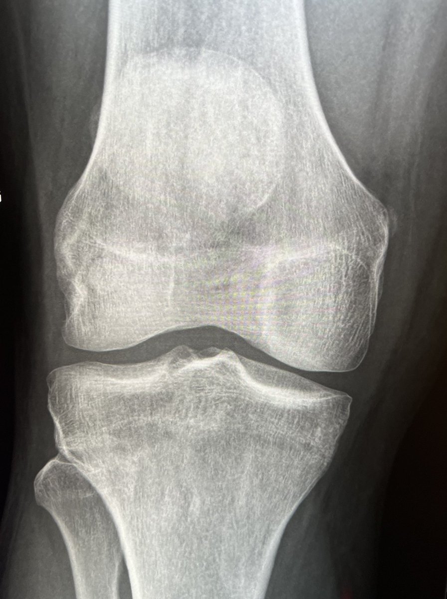 H/o injury followed by knee pain 

#radres #msk #radtwitter