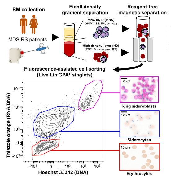 Hema_News's tweet photo. Experiments detailed in @CR_AACR demonstrated that #erythroid differentiation enhanced RNA mis-splicing in SF3B1-mutant myelodysplastic syndromes with ring sideroblasts. 

📓 https://t.co/OKT6Zwnmba https://t.co/W8PWgFnAII