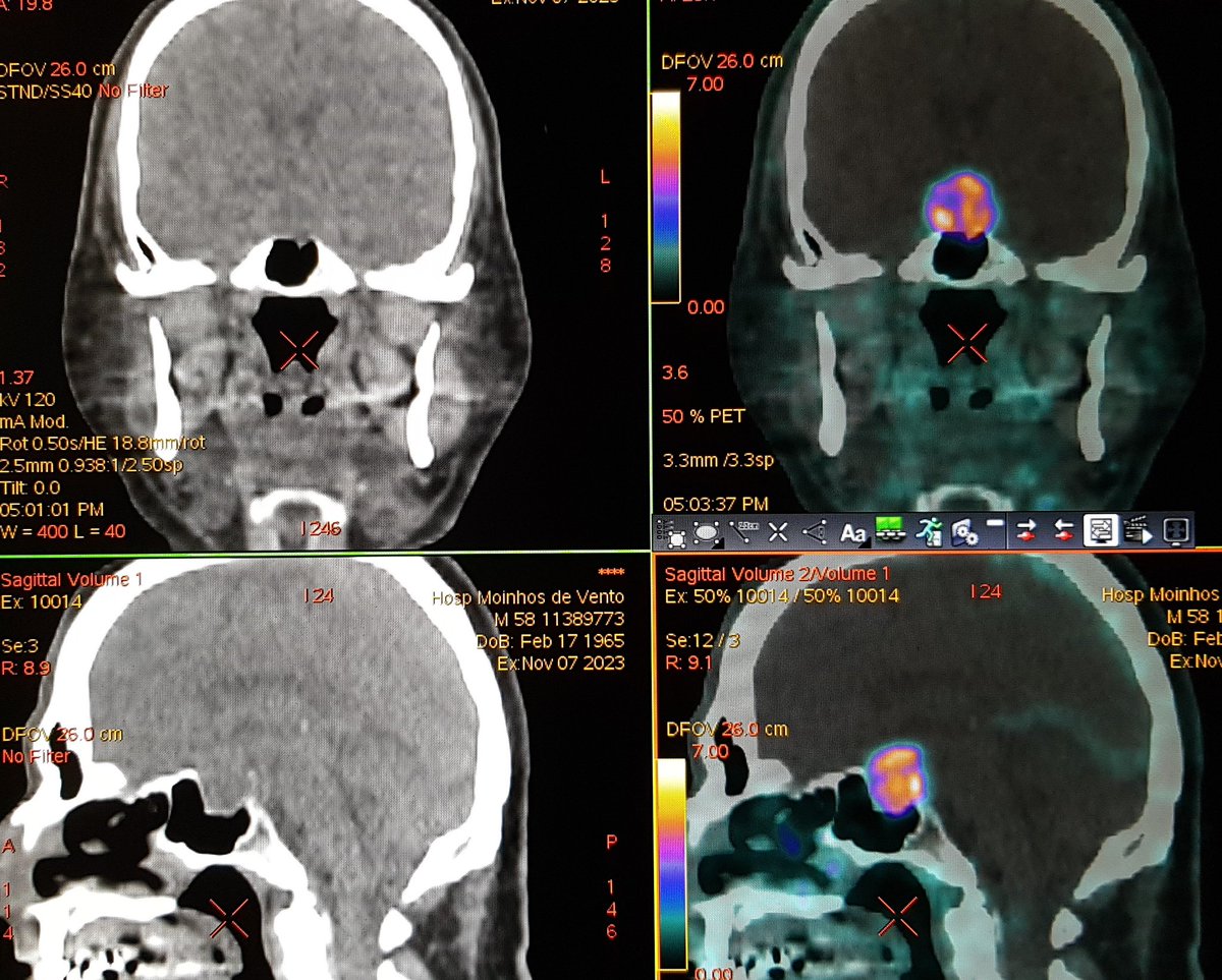 Jônatas Fávero (@jonatasfavero) on Twitter photo Incidental fiding on 68Ga- DOTATOC PET/CT. Enlarged pituitary gland. Probable macroadenoma. How would you report that? <a href="/Felipegaliza/">Felipe de Galiza</a> <a href="/ClinNuclearMed/">Clinical Nuclear Medicine</a> <a href="/DrMHofman/">Michael Hofman</a> <a href="/SchuchAlice/">Alice Schuch</a> <a href="/aline_spader/">Aline Spader</a> Incidental fiding on 68Ga- DOTATOC PET/CT. Enlarged pituitary gland. Probable macroadenoma. How would you report that? <a href="/Felipegaliza/">Felipe de Galiza</a> <a href="/ClinNuclearMed/">Clinical Nuclear Medicine</a> <a href="/DrMHofman/">Michael Hofman</a> <a href="/SchuchAlice/">Alice Schuch</a> <a href="/aline_spader/">Aline Spader</a>
