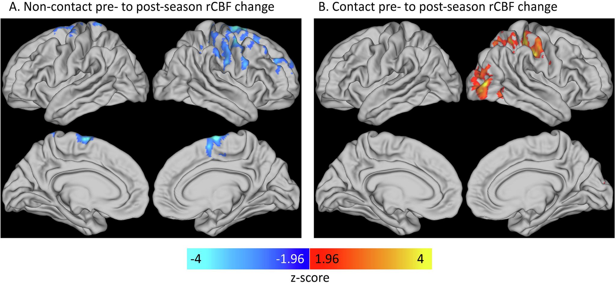 Change Of Season Scan Chris Nowinski, Ph.D. on X: "Researchers studied cerebral blood flow changes in 14 year-old contact vs. non-contact athletes - without #concussion - over 1 season. Wow. CBF change due to RHI "may
