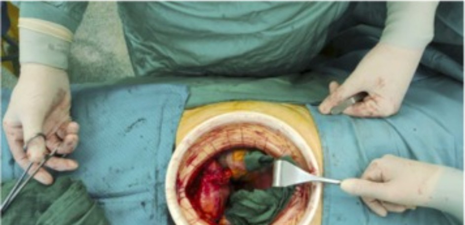 Daniele Castellani (@d_castellani) on Twitter photo Do you want to reduce surgical site infection after open radical cystectomy? A way is using a wound protector. Enjoy free reading of our paper <a href="/Roquito_9/">Rocco Francesco delle Fave</a> <a href="/carlo_giulioni/">Carlo Giulioni</a> <a href="/AAntezza/">Angelo Antezza</a> <a href="/leonardperpepaj/">Leonard Perpepaj</a> <a href="/mvittoria16192/">Maria Vittoria De Angelis</a> <a href="/GiulioMilanese1/">Giulio Milanese</a> #UroSome goldjournal.net/article/S0090-… Do you want to reduce surgical site infection after open radical cystectomy? A way is using a wound protector. Enjoy free reading of our paper <a href="/Roquito_9/">Rocco Francesco delle Fave</a> <a href="/carlo_giulioni/">Carlo Giulioni</a> <a href="/AAntezza/">Angelo Antezza</a> <a href="/leonardperpepaj/">Leonard Perpepaj</a> <a href="/mvittoria16192/">Maria Vittoria De Angelis</a> <a href="/GiulioMilanese1/">Giulio Milanese</a> #UroSome goldjournal.net/article/S0090-…