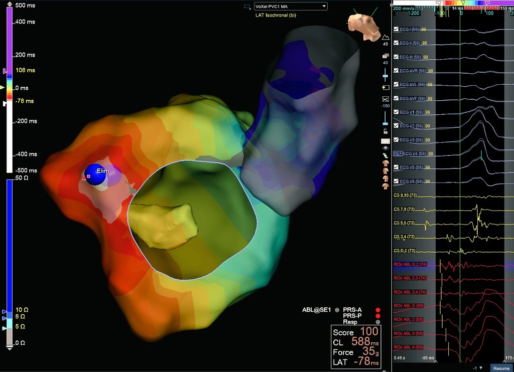 Hapa_EP's tweet photo. Anterolateral MA PVCs were successfully eliminated with ablation at this earliest site! This PVC had been inducing episodes of VT due to R on T phenomenon. #ablatePVCs #ablateVT ❤️‍🔥 https://t.co/rzdWCtDfQw